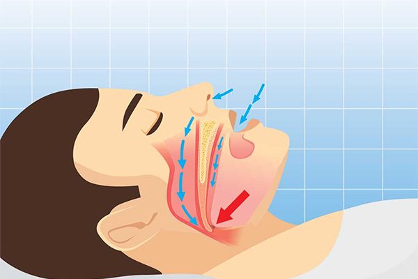 illustration of sleep apnea blocking airway
